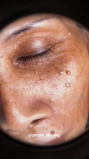 Amazing 🥰 #blackhead #supersatisfying #extractionsatisfaciton #pimplepop