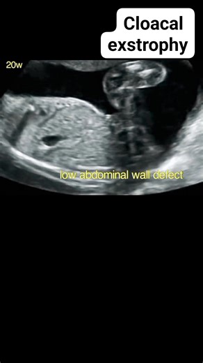 468 reactions · 171 shares | Cloacal exstrophy on ultrasound #fblifestyle #Baby #radiology #pregnancy #ultrasound #pregnant | Radiology Interesting | Facebook
