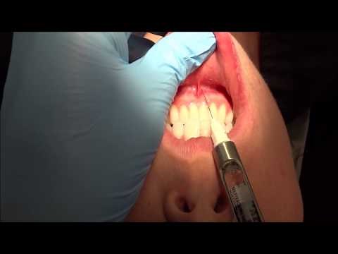 Cross-Innervation of Mandibular Anteriors