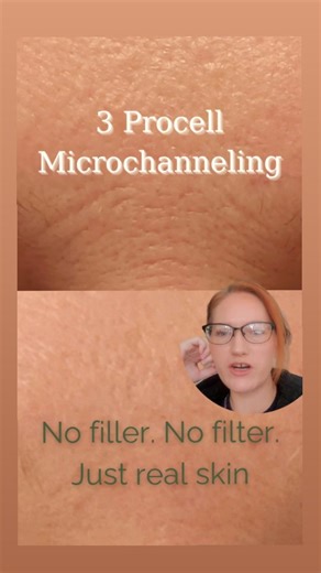 Solano Acne Clinic and Spa I Fairfield, CA on Instagram: "Three sessions. Real skin. Real change. These are my own results after 3 Procell Microchanneling treatments on fine lines, lip wrinkles, and acne scarring. No filters. No shortcuts. Just consistent, intentional skin work. This is what happens when you give your skin the right signals to rebuild. It’s not overnight magic—it’s collagen, time, and a plan that honors your skin. If you’ve tried everything and still don’t recognize your reflect