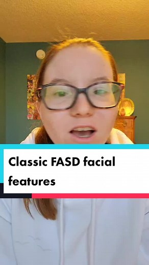 #greenscreen Classic FASD faciel features #FYP #fasdawareness #FASD #disabilitytiktokers #disabilityawareness #disabilitypridemonth