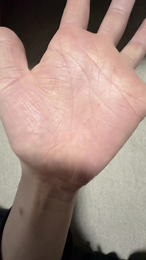 汗疱（異汗性湿疹）の対処法と原因｜手のひら・指先の水疱が出た時
