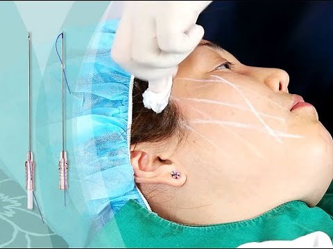 COG thread lifting - WhiteMedience