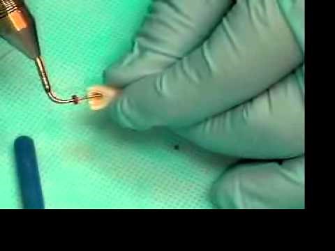 Video 11 Obturation with warmed Gutta-Percha