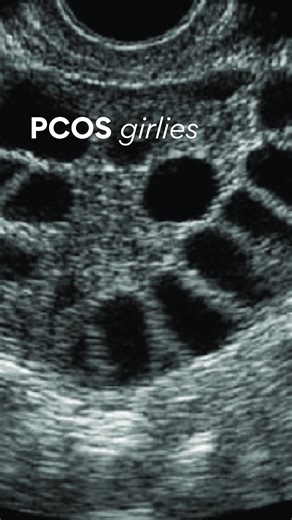 Dr. Xiaoqian Wang-Gilchrist | Sydney Fertility Specialist on Instagram: "As a fertility surgeon, this is exactly what I would do if I had PCOS 👇🏼✨ First, I’d understand what’s actually driving it. PCOS is typically powered by this loop: Insulin resistance → Higher insulin → Higher androgens (testosterone) → Irregular cycles + acne + hair changes + ovulation issues So instead of only focusing on the ovaries… I’d focus on insulin sensitivity 🧠💡 The most powerful non-medication tools? 🏋🏼‍♀️ S