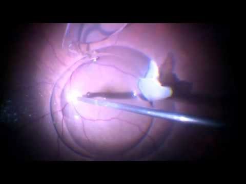 Vitrectomy for removal of dislocated IOL and lens matter | Dr Manish Nagpal