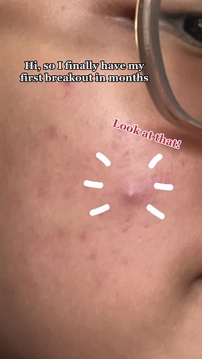 Cosrx AC Collection Acne Patch Review & Application Tips