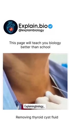 BIOLOGY | MEDICAL | HEALTH | Watching a thyroid cyst fluid removal is a fascinating look at medical science in action. ✂️ This procedure is a perfect example of how... | Instagram