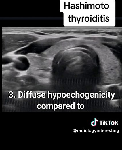 Understanding Hashimoto Thyroiditis Through Ultrasound