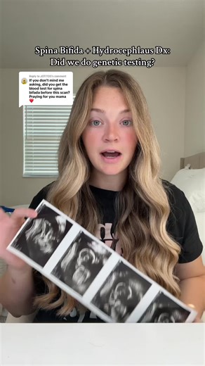 Replying to @JOTITOS our personal preference 🫶🏼 her full chromosomal analysis has came back normal from the amniocentesis we did after receiving her diagnosis #20weekanatomyscan #anatomyscan #myelomeningocele #spinabifida #pregnant #pregnantlife #nicu #nicunurse #momsoftiktok #foryou #medicalmom #genetictesting