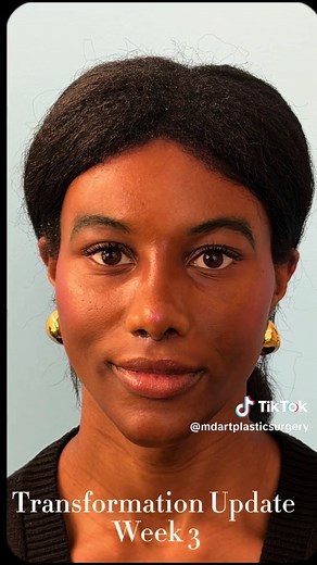 Facial Feminization Transformation Journey: Week 3 Insights