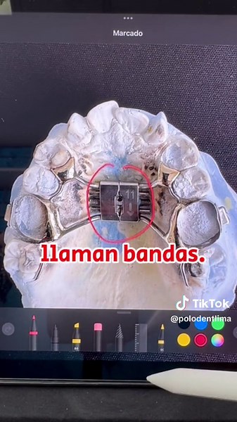 Hyrax: El Expansor Fijo para Niños