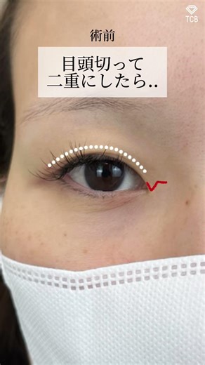 【目頭切開】垢抜けたい人は必見
