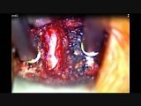 1 Level Stand Alone Anterior Cervical Discectomy and Fusion  • Video • MEDtube.net