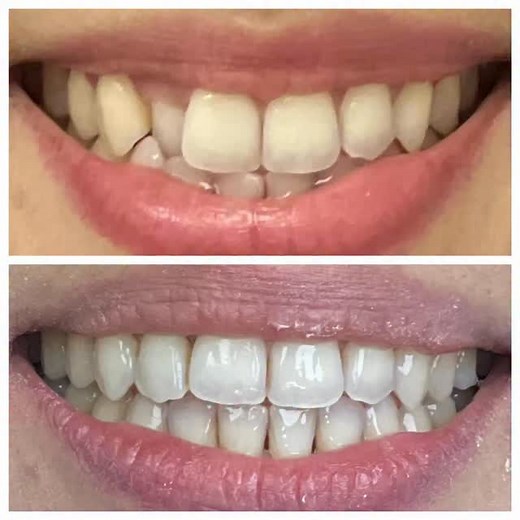 The before and after Invisalign and composite bonding. What an amazing results 😍 | Family Smile Dental