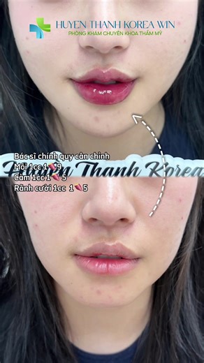 Filler Hàn VIP 3🍠/cc Sale 50% chỉ còn 1🍠5/cc. Bác sĩ thực hiện tại phòng khám cấp phép, kinh nghiệm 10 năm #huyenthanhkoreawinclinic #fillerbotox #fullface @Huyen Thanh Korea (Win Clinic) @HuyenThanh Korea phẫu thuật TM