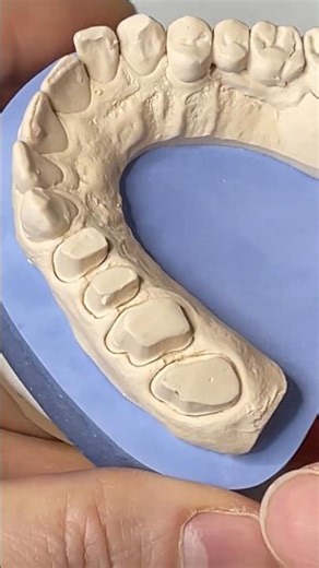 Plaster model for the perfect all-ceramic crowns
