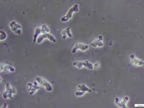 A 14-year-old boy dies within 5 days after nasal water exposure. Diagnosis?❓ A) Granulomatous amebic encephalitis B) Primary amebic meningoencephalitis C) Cerebral malaria D) Tuberculous meningitis(CSF microscopy 👇)