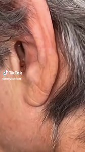 Spider in Ear Extraction - Shocking Video Footage