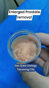 5.9K views · 62 reactions | Enlarged prostate removal  | Doc Drew Valdez - Urology | Facebook