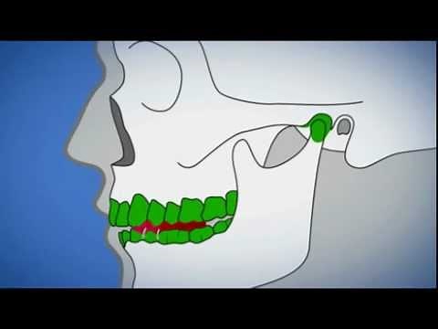 Funktionsstörung des Kiefers