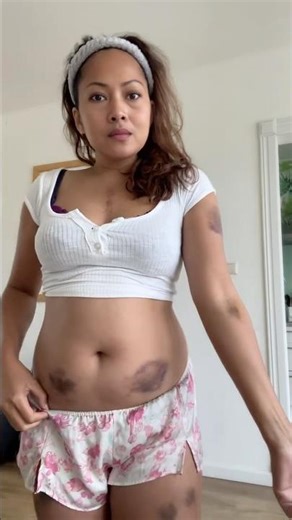 “Living with Blood Thinners: The Truth Behind My Bruises”