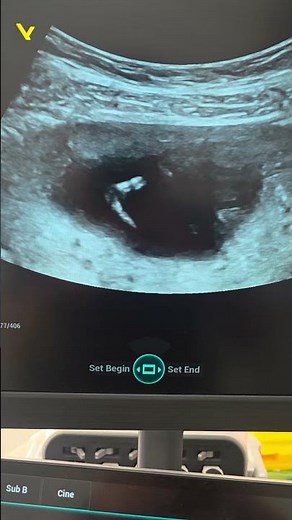 13 weeks fetus in ultrasound exam