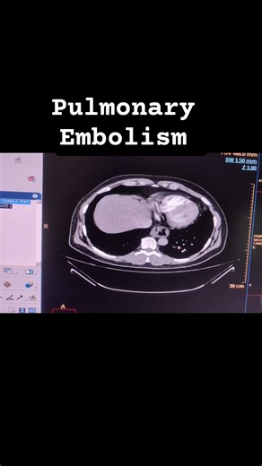#pulmonaryembolism #radiologystudent #physics #anatomy #ct #science @avnishradiology