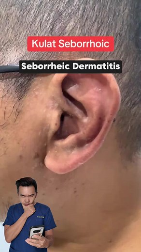 What usually helps: • Antifungal cream on the affected area • If stubborn, stronger antifungal treatment may be needed How to use: Apply treatment on clean dry skin consistently, and avoid picking at the flakes. If this keeps coming back, it’s worth getting checked properly. Have you ever had this happen around your ears, eyebrows, or scalp too?