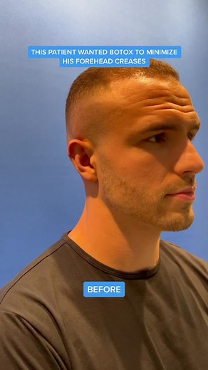 Using Botox to minimize forehead creases #bcfp #botox #wrinkles #malebotox #foreheadcreases #boston