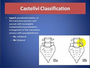 Lumbosacral Transitional Vertebra