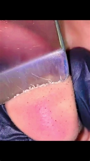 #blackhead #extractions #pimple #viral #viral