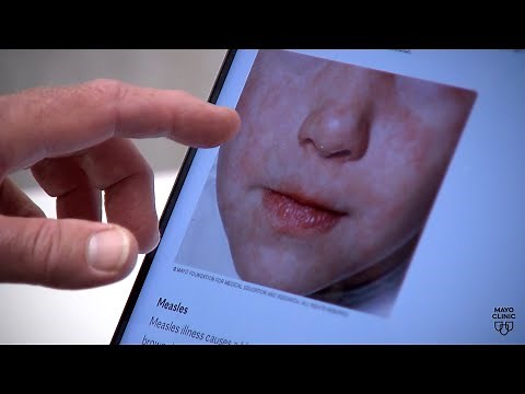 The science behind the measles virus