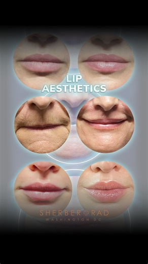 Ariel N. Rad, M.D., Ph.D., F.A.C.S. on Instagram: "👄 Beautiful lips are central to facial harmony. Along with the eyes, they form the lower point of the Yarbus triangle — the subconscious focal zone humans scan to interpret beauty, expression, and emotion. 📐 Lip aesthetics aren’t about size; they’re about proportion and relationship: a balanced 2:3 upper-to-lower lip ratio, 1–2 mm of upper tooth show at rest, and harmony with the nose, teeth, and overall facial frame. To refine lips, I rely on