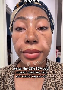 35% TCA peel at home — my 4-layer chemical peel experience