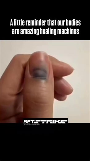 SnapFactAttack on Instagram: "This time-lapse video documents the entire healing process of a thumbnail that suffered a significant injury, resulting in a subungual hematoma (blood under the nail, causing the dark, black appearance). The footage shows the healthy, pink nail slowly growing out from the nail bed, pushing the damaged, discolored portion forward over several months. Eventually, the old, injured part of the nail detaches and falls off completely, revealing the fully regrown, healthy 