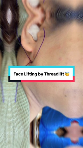 Understanding Threadlift: The Non-Surgical Facelift