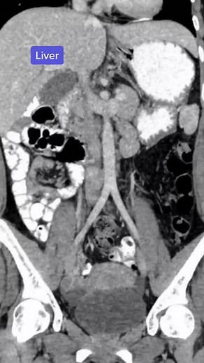Identifying Normal Organs on a CT Scan