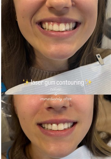 We fixed up her naturally gummy and uneven smile and still kept things 100% natural. ~20 mins chair time, painless, no stitches, easy healing. Pics are before and immediately after (hence the little bit of 🩸). FYI this is an elective cosmetic procedure.