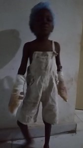Update: Baby Blessed is still at the hospital receiving treatment, Apparently, her two arm were both immersed in the boiling water . The skin are gone . The wounds are very bad . Hopefully we are able to get help for her . As much as I would want the mother to be locked up , I am informed that she’s the one tending to her and the only caregiver at the hospital with her and they want the girl to be fine first before we initiate any step despite all efforts . It’s annoying right now? We have been 