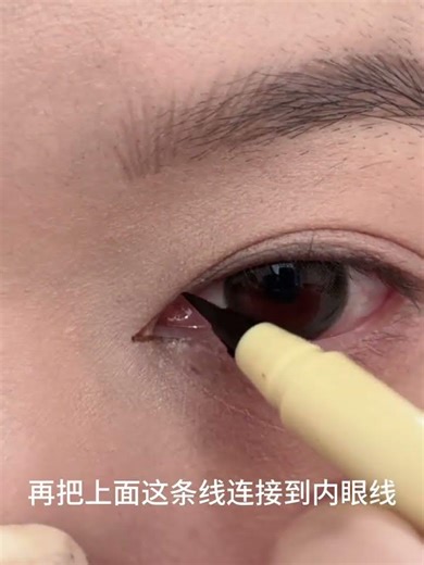 Master the Art of Epicanthus Removal - Open Up Your Eyes