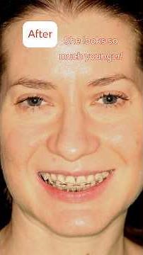 MSE - Adult palatal expansion, a real case in the post expansion, orthodontic phase.