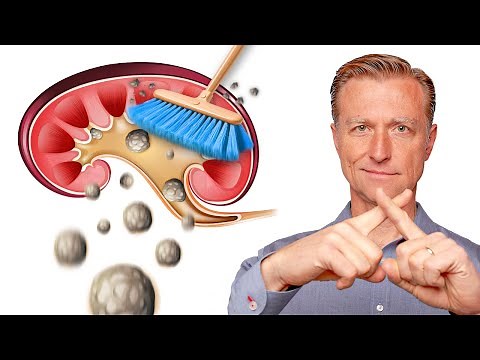 Clean Out Your Kidneys of Oxalates and Stones - Dr. Berg