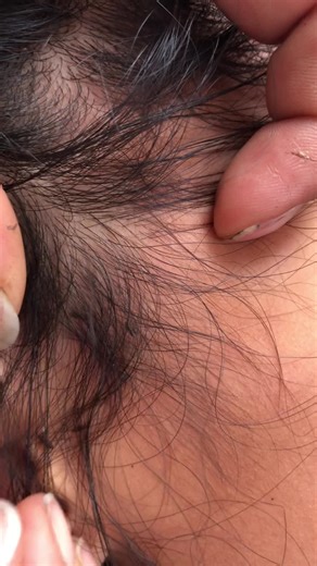 with these nails i wont let them escape#😭😭😭 #lice #😱😱 #liceremoval #😰😰 #Remova