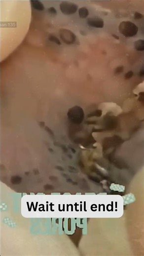 Deep Blackheads, Milia & Whitehead Removal pimple popping New| Big Cystic Acne Extraction #1213 2026