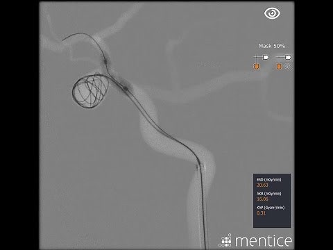 Mentice Neurovascular Brain Aneurysm Coiling Demo