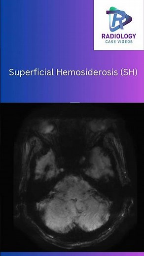 Superficial Hemosiderosis#SuperficialHemosiderosis#NeuroRadiology#MRIImaging# SusceptibilityMRI