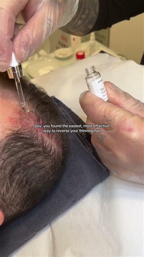 Reverse Thinning Hair with Microneedling + Targeted Serums 💉✨