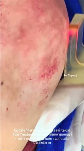 Treatment technique for keloid scars using the Discovery Program: Pico Laser + Fractional Ablativ...