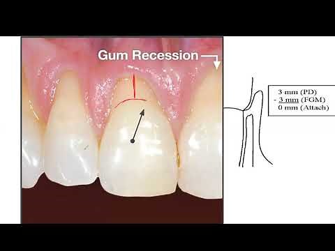 FG Margin, Recession & Periodontal Attachment Loss